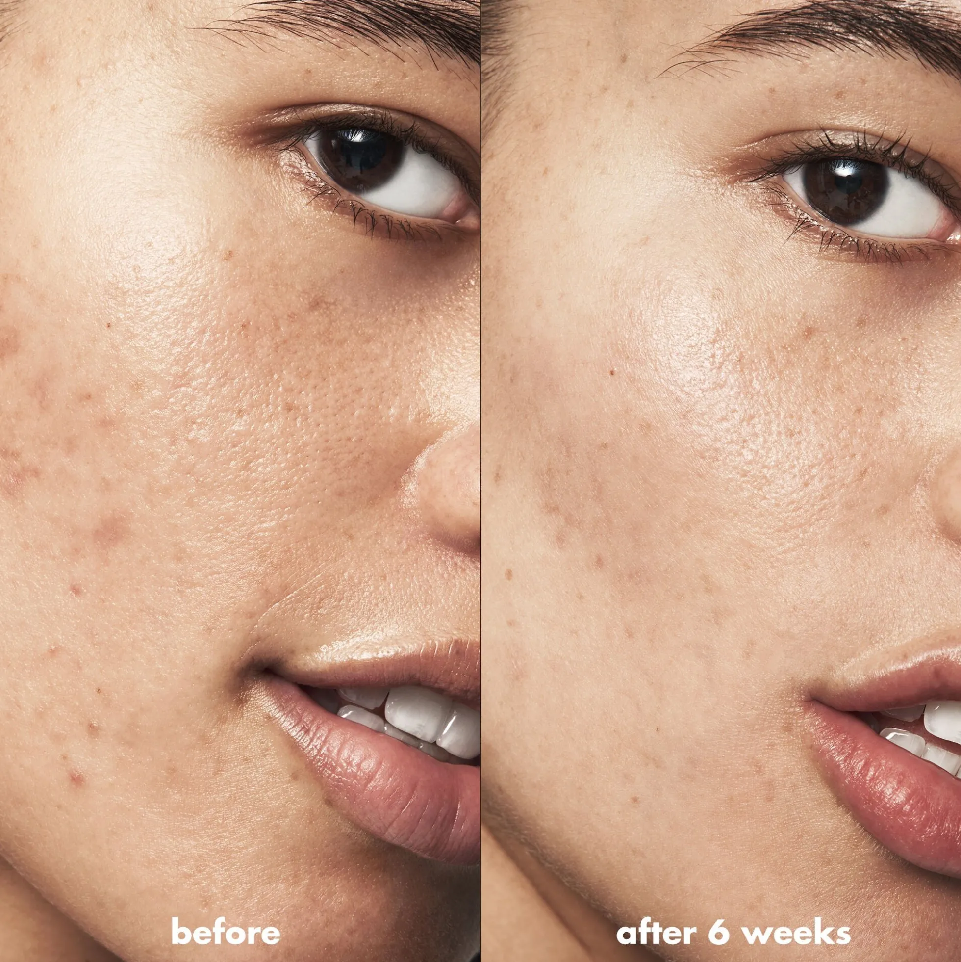 Blemish Breakthrough Acne Calming Water Cream