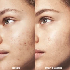 Blemish Breakthrough Acne Clarifying Cleanser