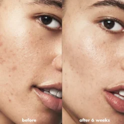 Blemish Breakthrough Acne Clarifying Cleanser